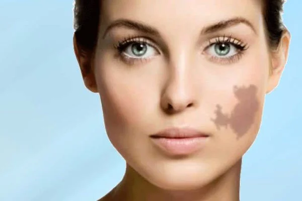 Birthmark removal