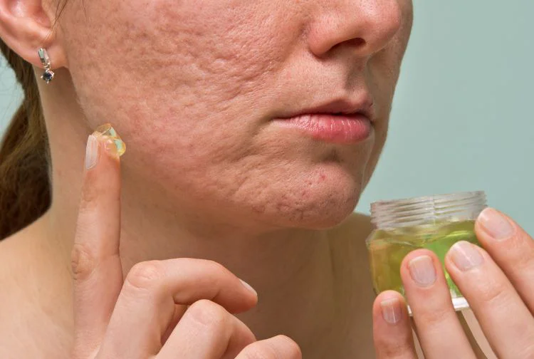 Chickenpox and pitted scar treatment