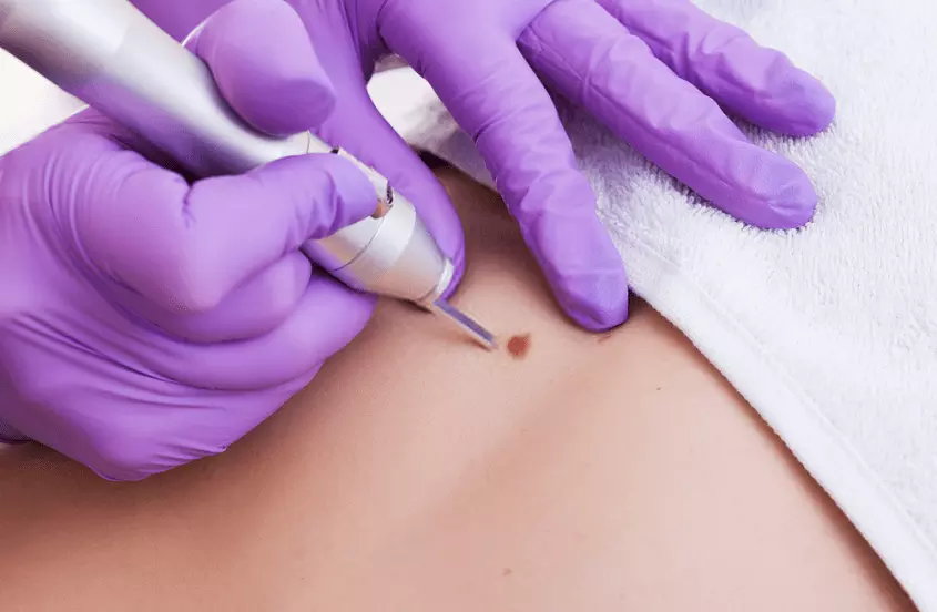 Mole and wart removal
