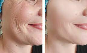 Wrinkles and freckles treatment